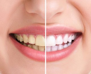 4 aliments qui blanchissent naturellement les dents